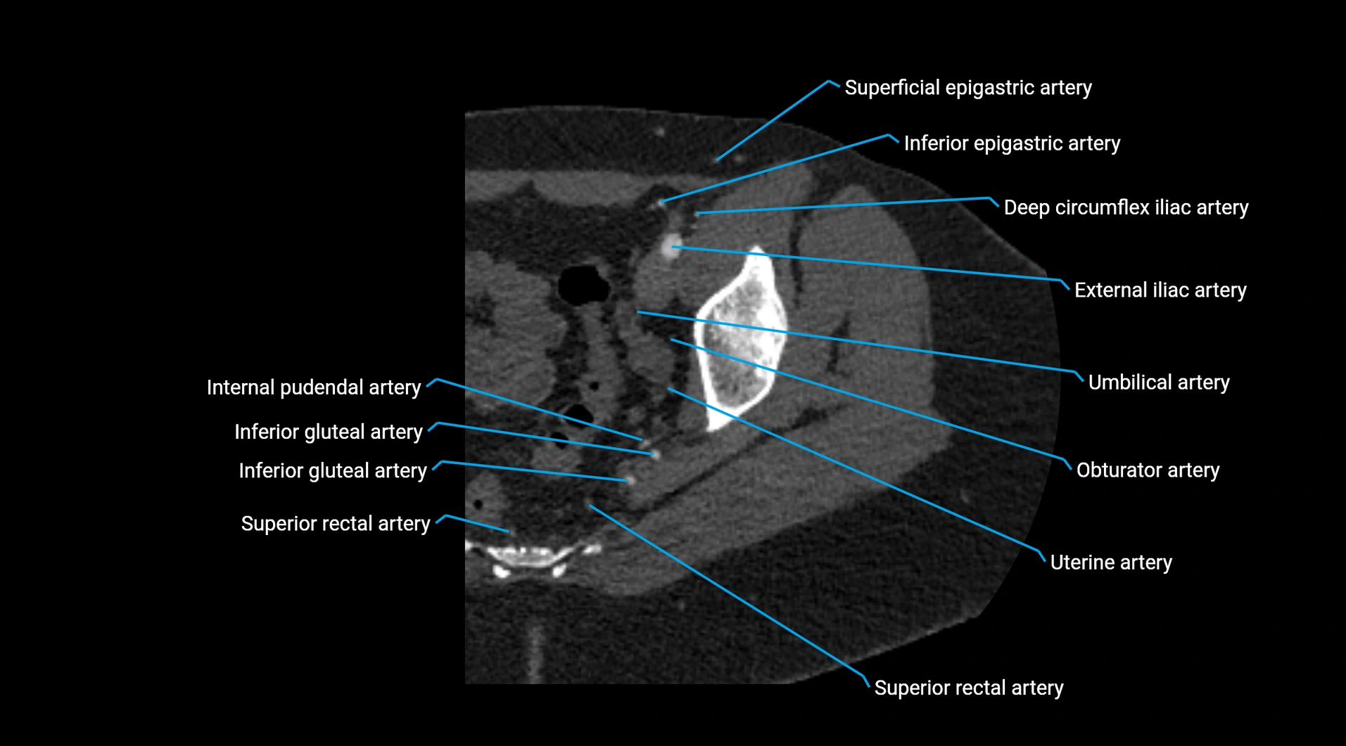 CTA lower limb cross sectional anatomy labelled image _46.webp